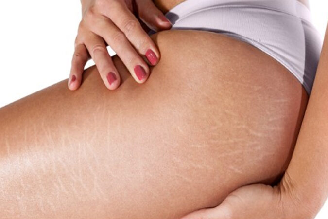 hyperpigmentation